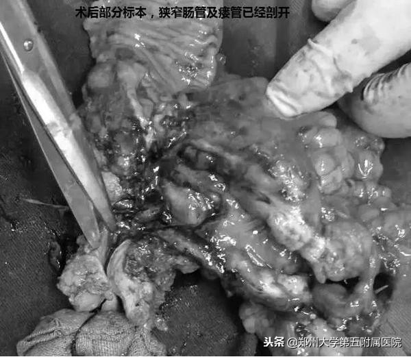 十来年肠绞痛的表现和处理方法,十年腹痛