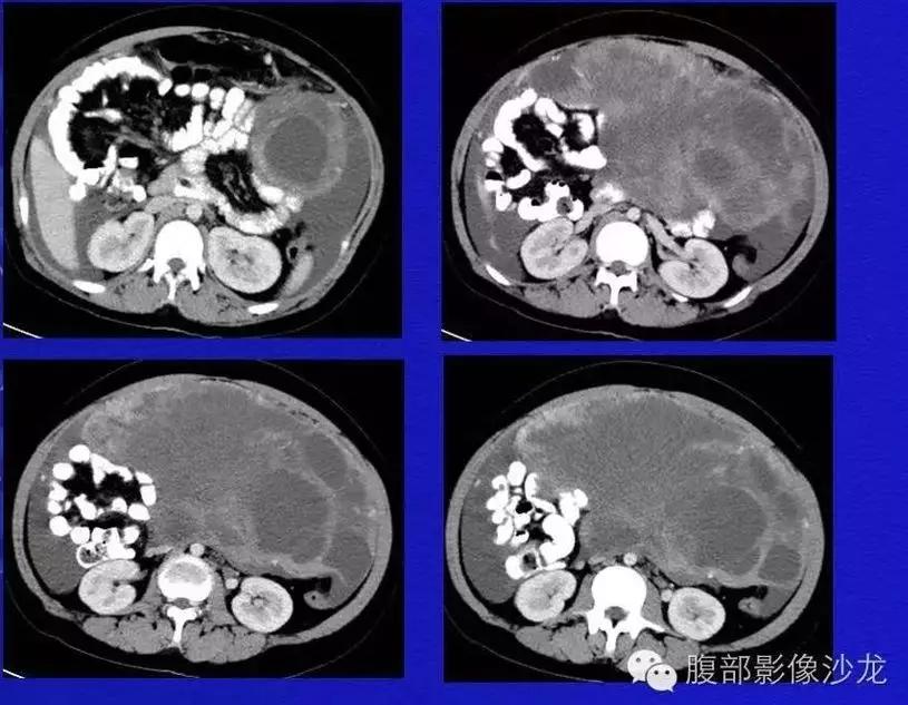 卵巢原发肿瘤的分析思路