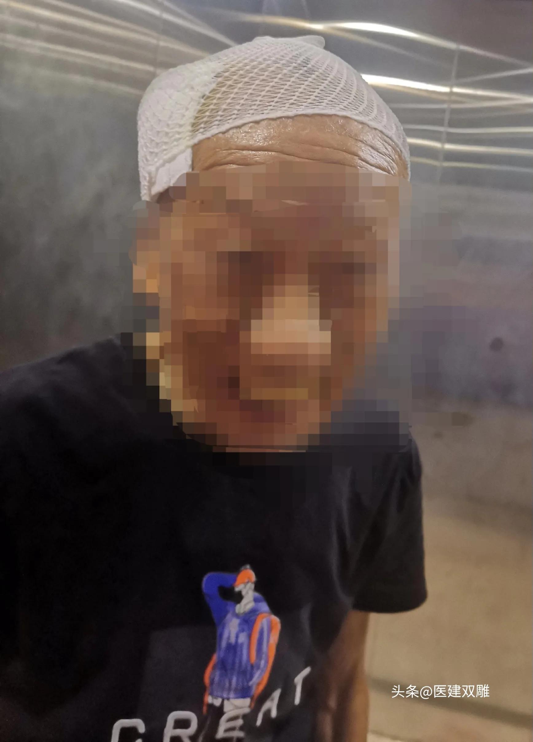 病例分享案例,硬膜下血肿病例