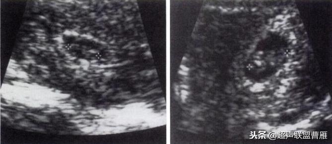 内见卵黄囊,卵黄囊肿瘤