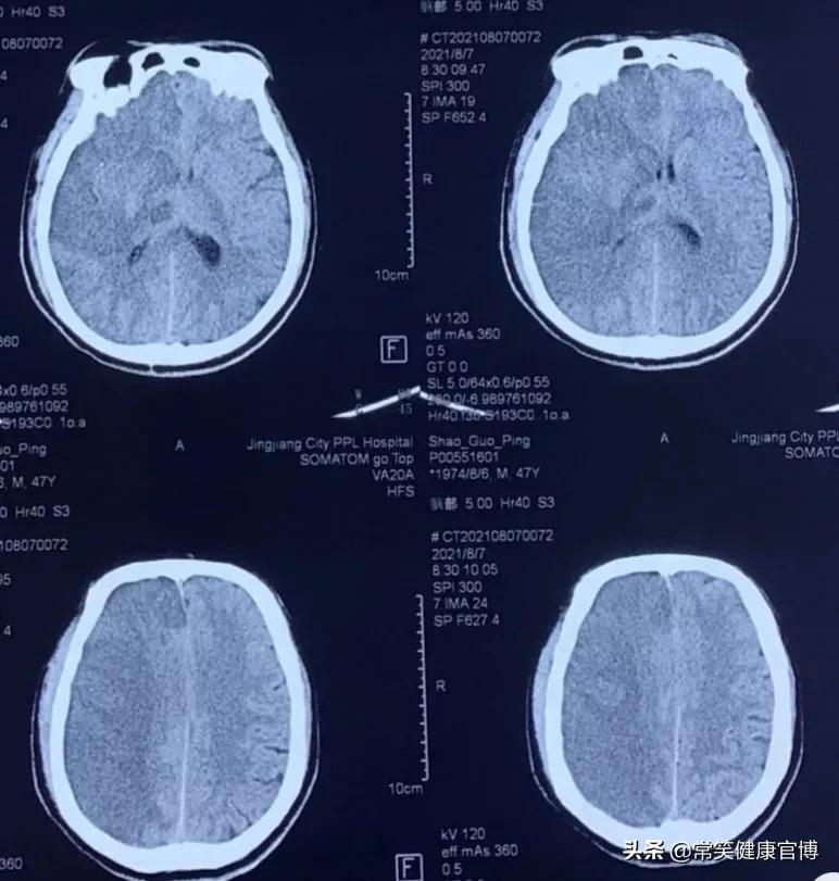 去骨瓣减压术后脑梗如何处理,去骨瓣减压术头骨如何恢复
