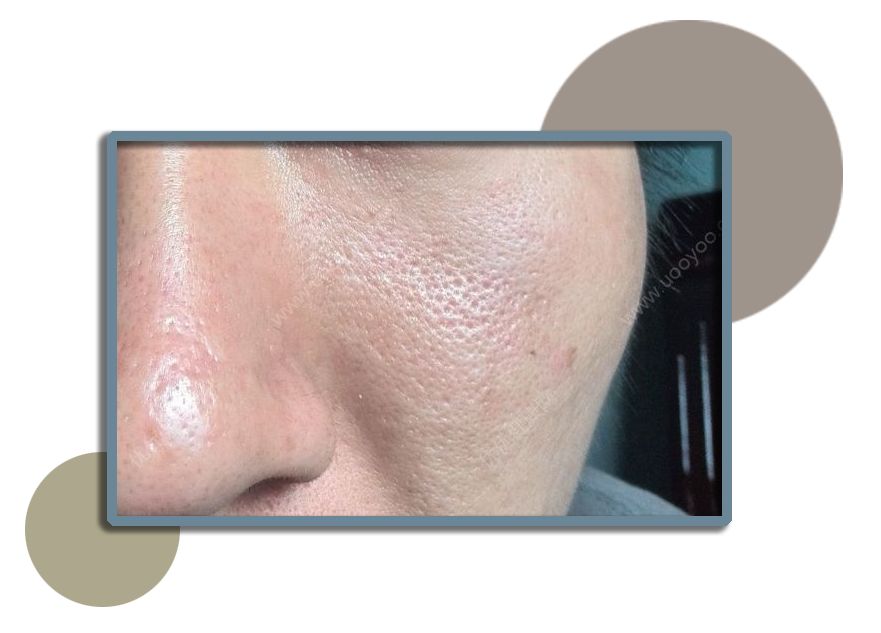 控油清洁毛孔,清洁控油收缩毛孔步骤