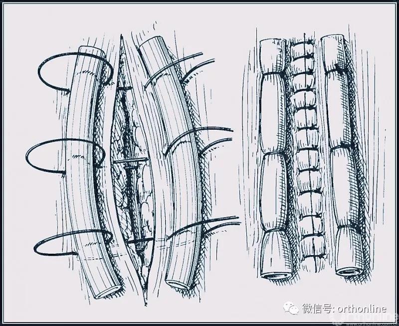 十种外科基本缝合方式详解,手术切口缝合有哪几种