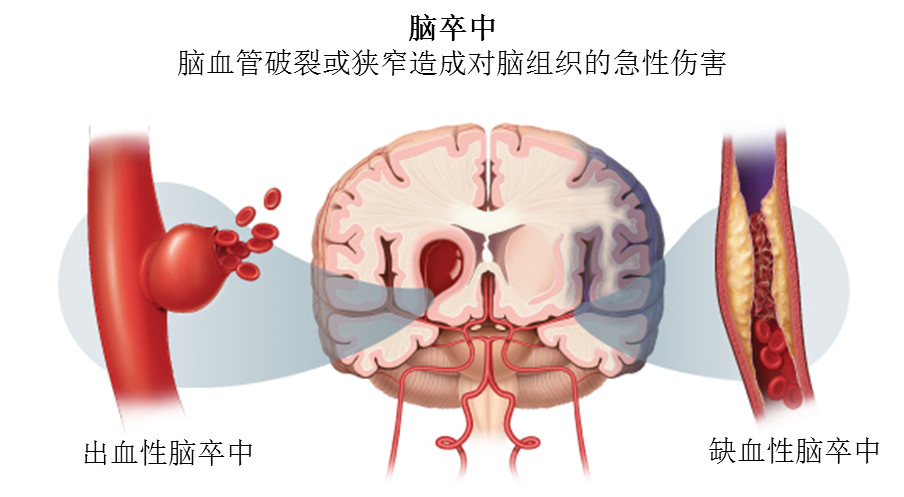 脑卒中如何治疗,脑卒中是什么如何康复治疗