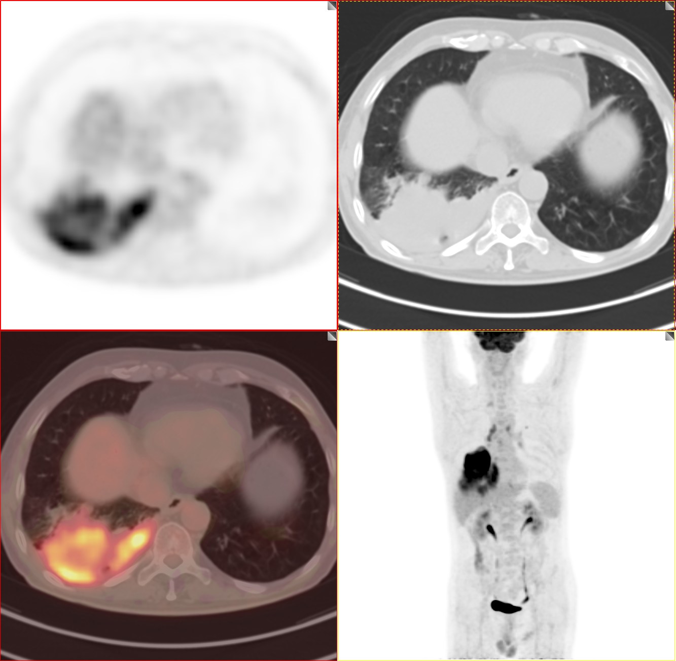 petct肺癌晚期必须要做吗,肺癌患者petct