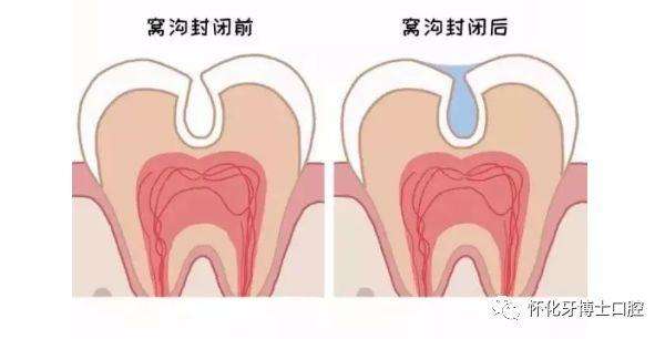 乳牙坏了不用管有恒牙代替对吗,乳牙坏啦不补牙会影响恒牙吗