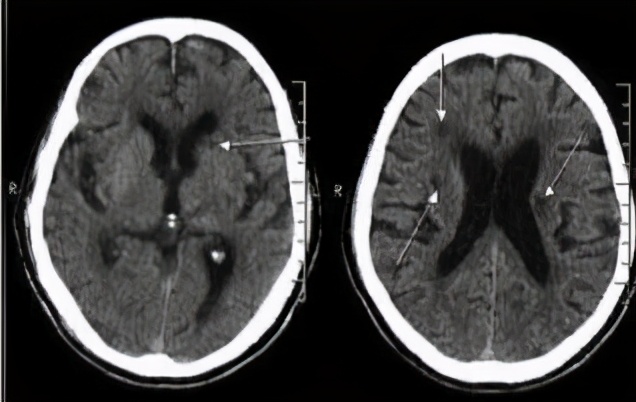 高血压心脏病有什么症状表现,肾性高血压的症状表现有哪些