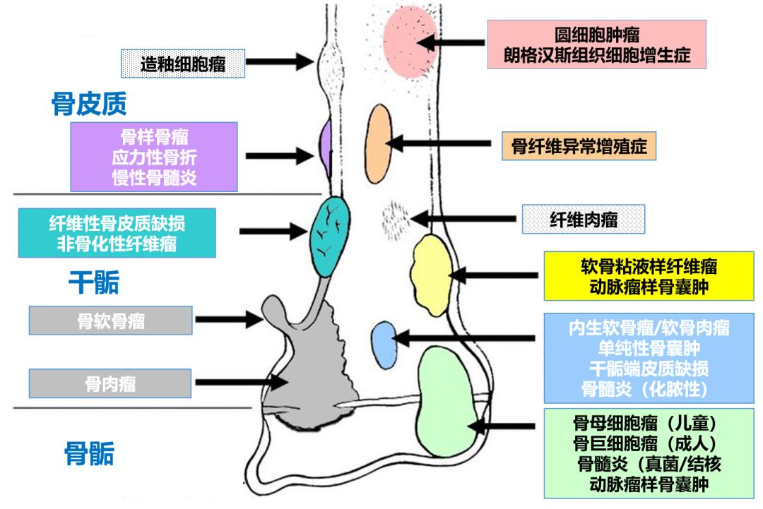 骨肿瘤常见问题解答