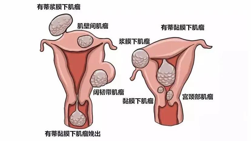 专家讲子宫肌瘤,如果怀孕了发现有子宫肌瘤怎么办
