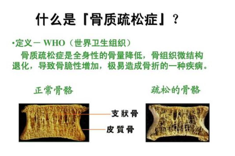 “骨头老了”怎么办？要补钙吗？医生说：有些需要补，有些不需要