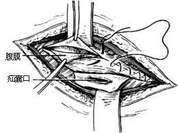 老年腹股沟疝气保守治疗有效方法,疝气中医治疗怎么锻炼有助于恢复