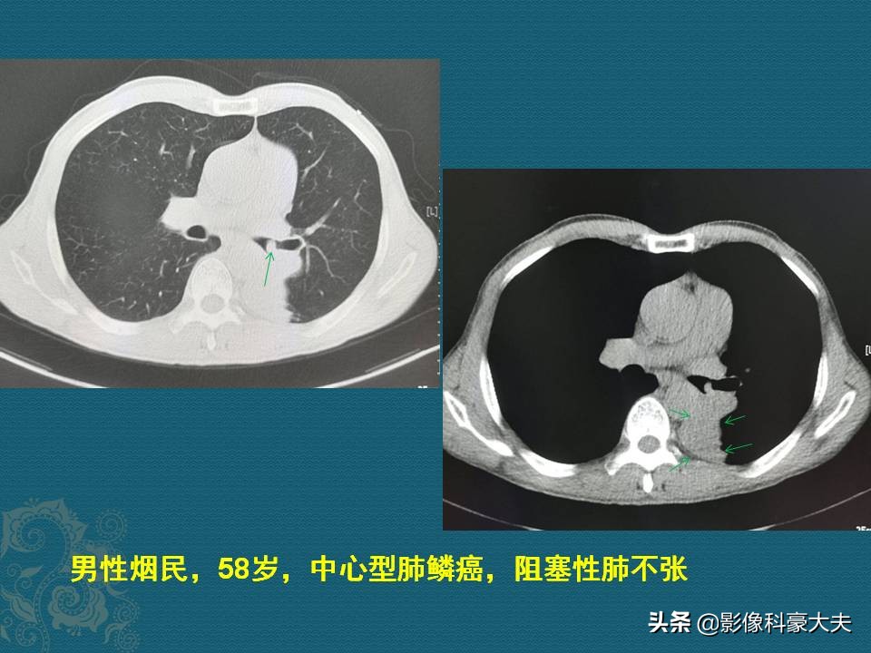 肺癌怎样才算局部晚期症状,肺癌分几种类型怎么吃药