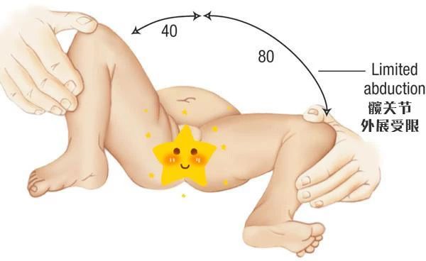 新生儿臀纹不对称双腿一样长,宝宝双腿纹路不对称有没有影响