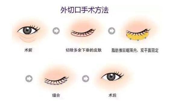 暂时性眼袋大什么原因引起的,暂时性眼袋怎么治疗