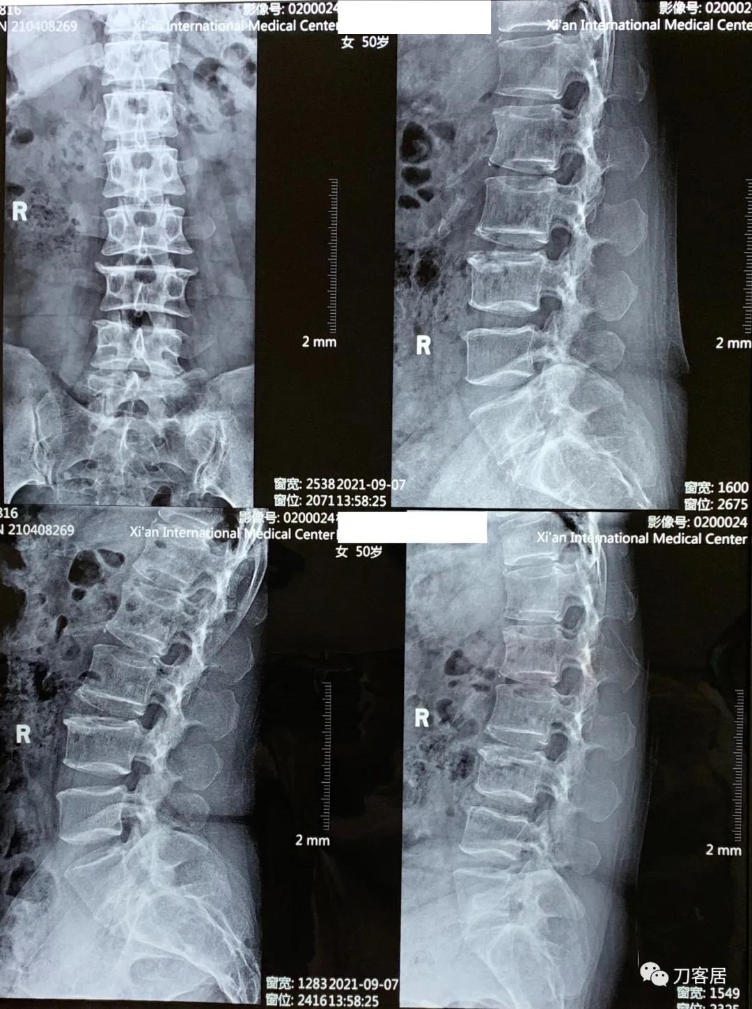 左下肢疼痛病历,门诊腹痛病历