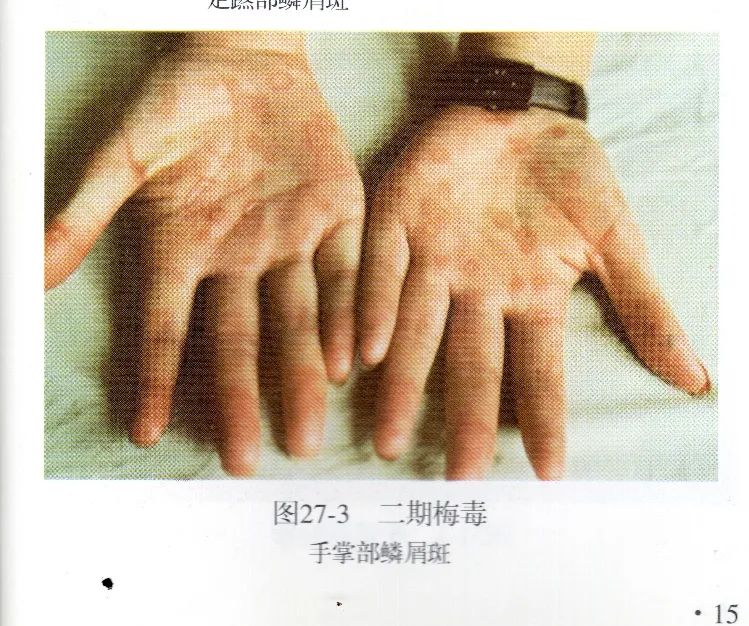 美国人到底有多可恨?用黑人做梅毒实验,这次美国各界都震撼了