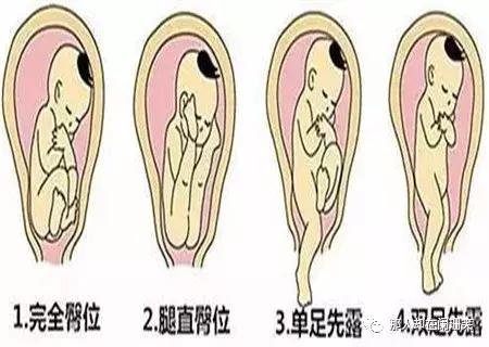 胎儿头位和右位的区别,胎儿头位和头位低的区别