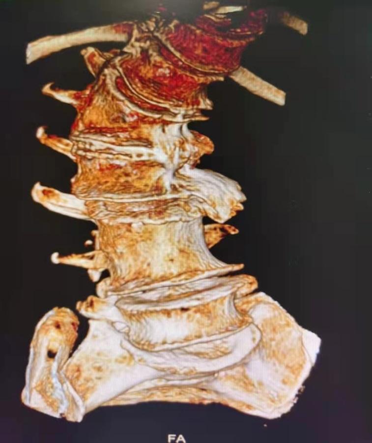 腰椎侧弯35岁能矫正吗,腰椎侧弯20度严重吗