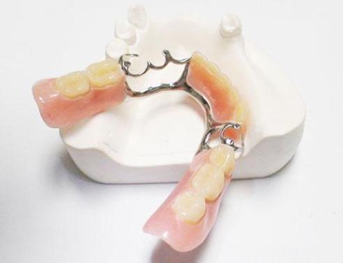 单颗门牙缺失牙桥修复,固定桥修复缺失牙