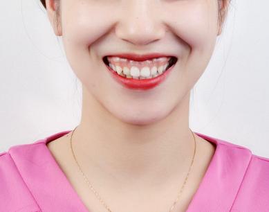 小孩子一笑露牙龈怎么办,一笑就露牙龈有什么说法