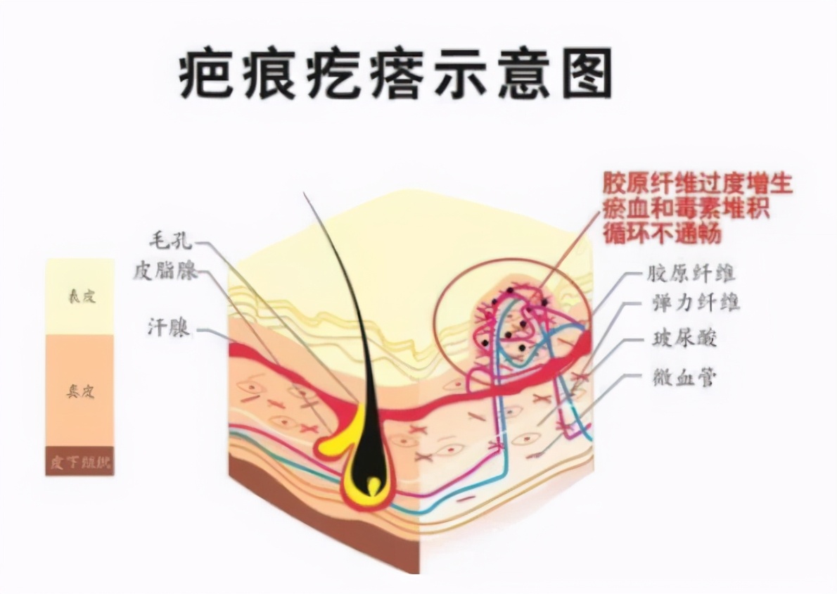 打软化针注意事项,瘢痕疙瘩软化针