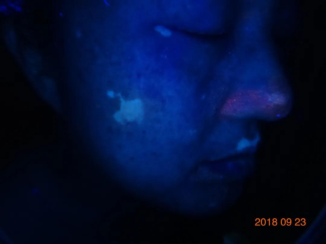 一位散发型白癜风患者的自白：坚持治疗能痊愈，千万别放弃自己