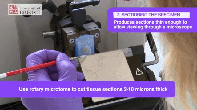 病理报告为什么这么慢,手术后病理报告准确率高吗