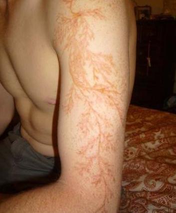 人被雷劈中会发生什么,人被雷劈过后会怎么样