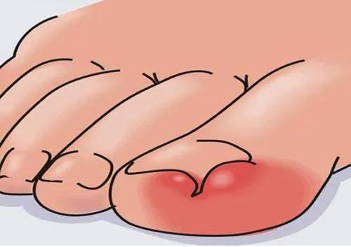 儿童怎么预防甲沟炎,美甲能预防甲沟炎吗