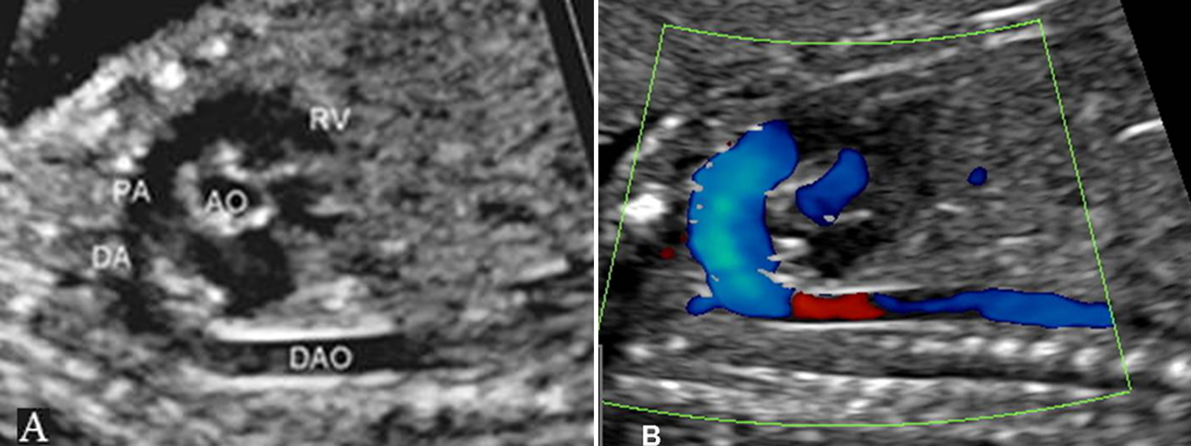 做普通的彩超能不能看到胎儿心脏,做彩超能知道胎儿准确多少周吗