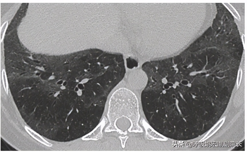 肺间质性肺炎可以治好吗,间质性肺炎需不需要肺部灌洗