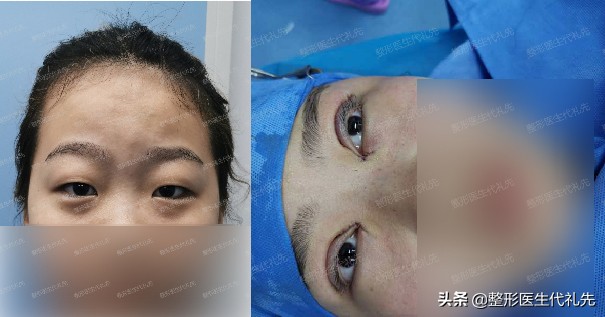 面部松弛提拉最好的方法,面部松弛下垂最好的提拉手术