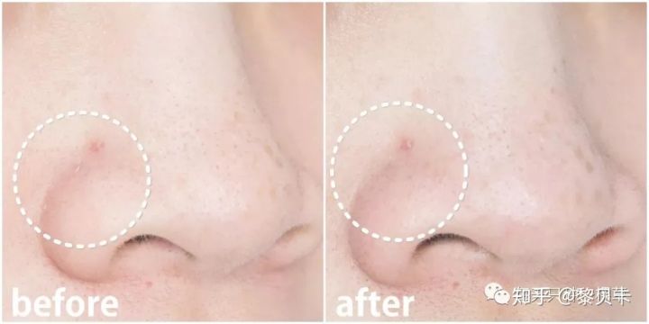 公认最好用的去黑头神器,网红推荐去黑头神器