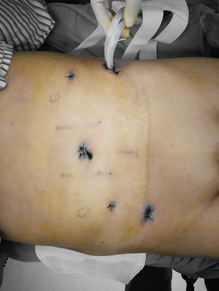 哈医大一院肠息肉手术专家,哈尔滨肿瘤直肠外科专家排名