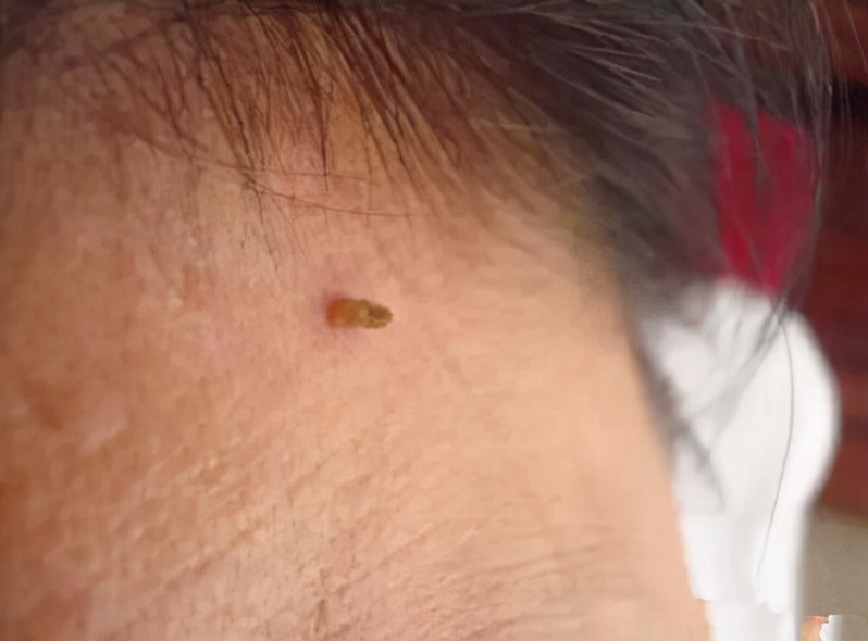 脖子上长的小肉粒揪下来会怎样,脖子和腋下长小肉球是什么原因