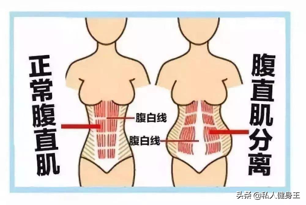 很多宝妈产后漏尿才想起来修复,产后改善漏尿的动作和方法