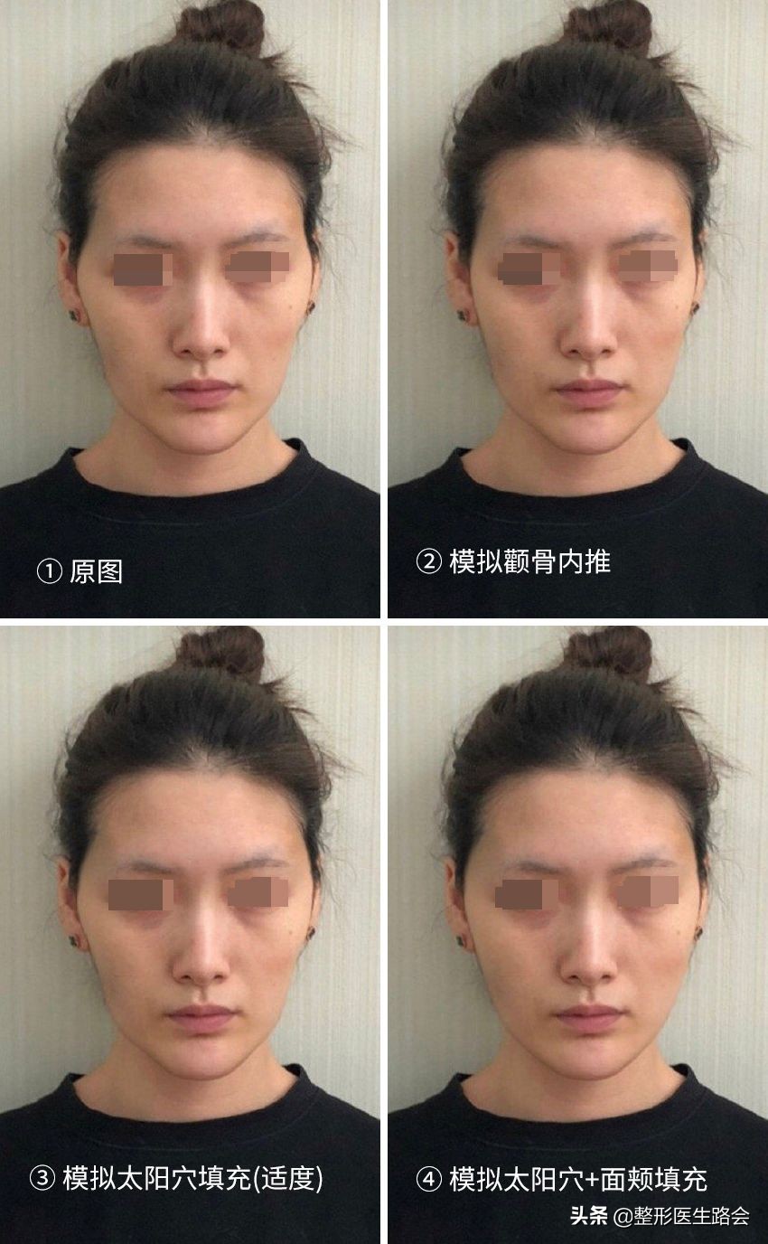 太阳穴凹陷颧骨高适合留中分吗,太阳穴凹颧骨高用什么哑光高光好