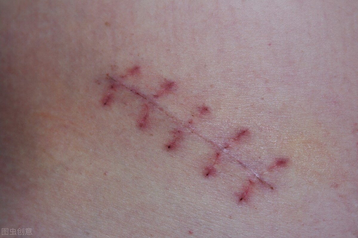 伤疤要怎么才能消除,伤疤怎么才能彻底去掉