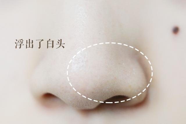 去黑头最好的套装,草莓鼻去黑头套装