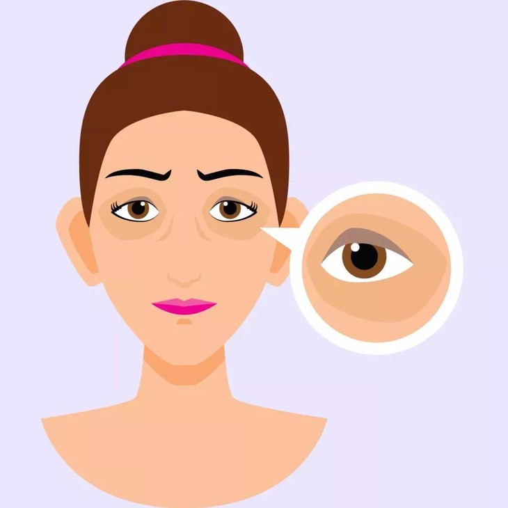 上眼皮黑眼圈是什么类型,黑眼圈的三种类型