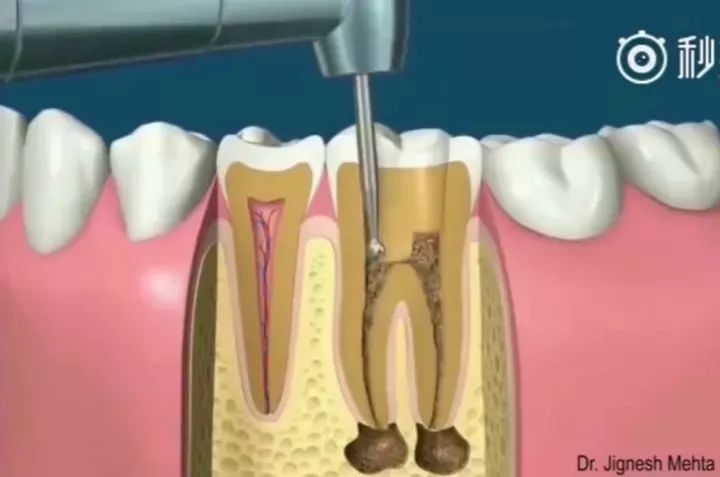 蛀牙了十几年还需要做根管治疗吗,蛀牙了一个小洞要根管治疗吗