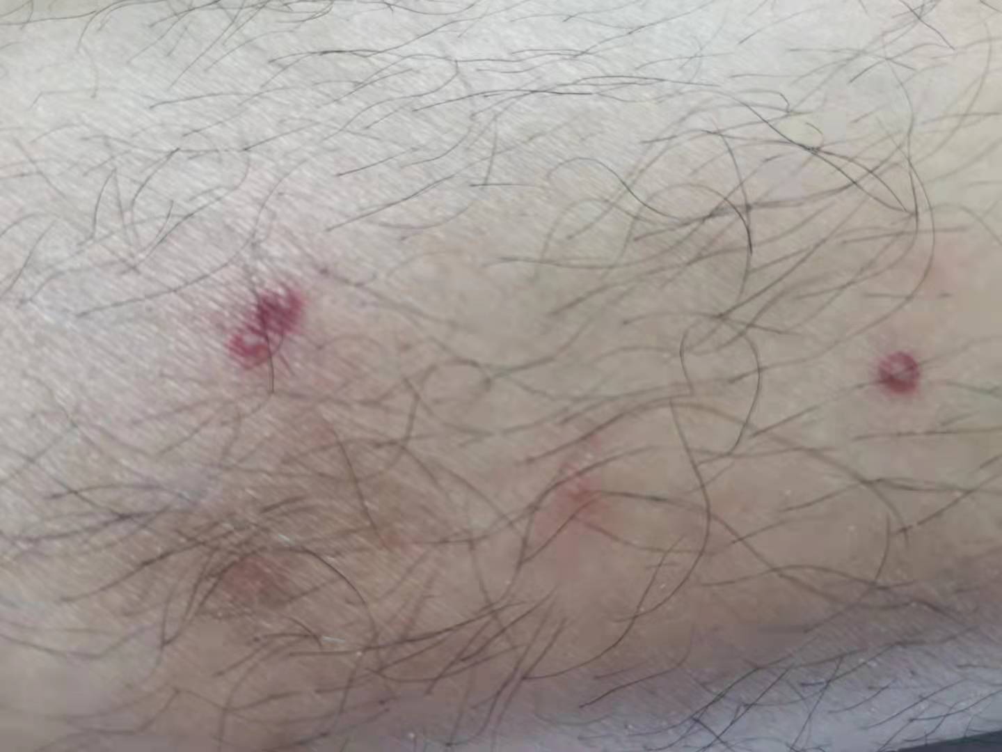 湖北20岁小伙感冒发烧,25岁小伙突然偏瘫