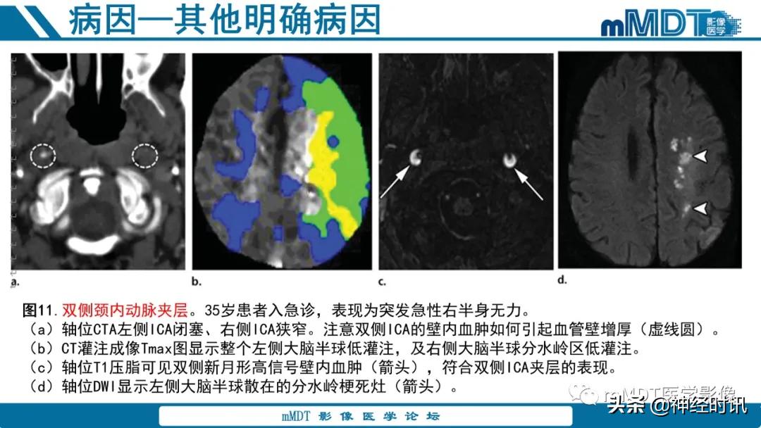 缺血性脑卒中护理课件,缺血性脑卒中讲课ppt