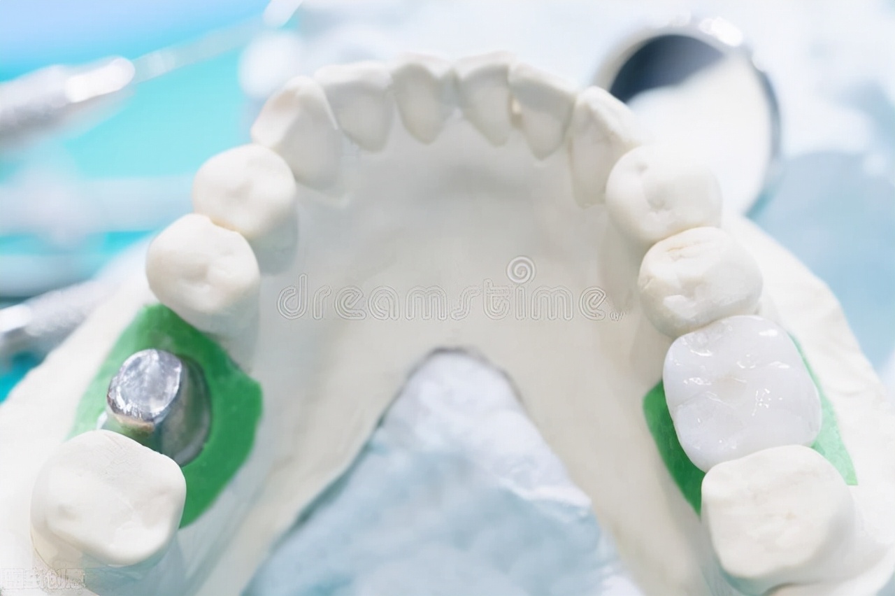 种植牙齿需要多少钱全过程,种植牙齿的全过程需要多少钱