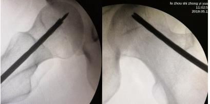富血小板血浆治疗骨头坏死,富血小板血浆prp疗法多久见效