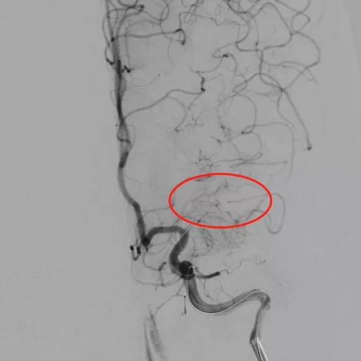 颅内动脉支架成形术，让塌陷的颅内动脉重获新生