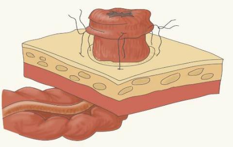 结肠癌造口术后胀气怎么回事,结肠癌手术后造口间歇性流血