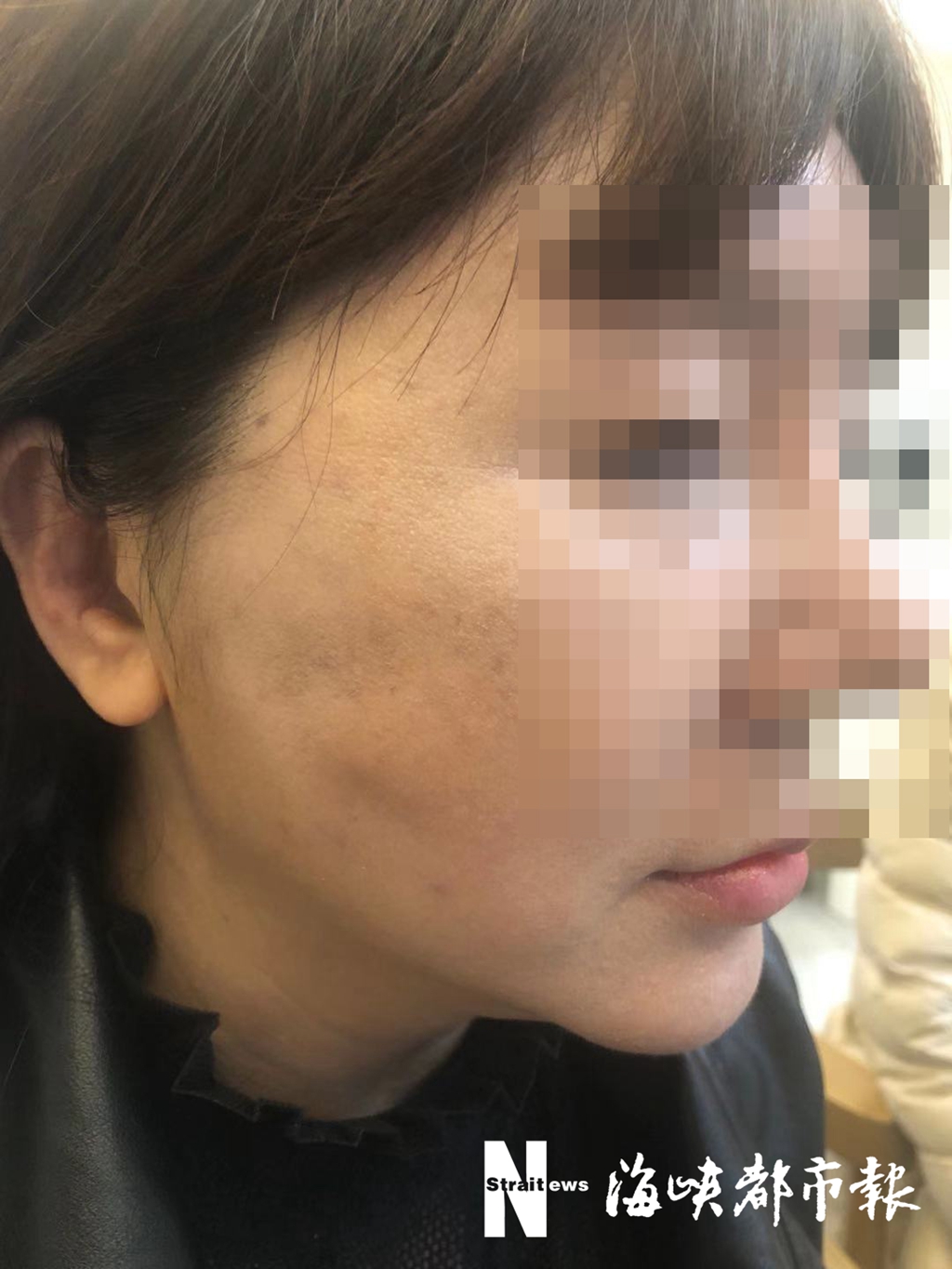 一女子花两万多元美容,一名女子花了17000整容失败