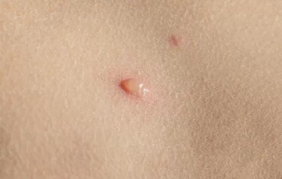 杭州70岁老伯下身长了20cm这东西，因“羞耻”不去医院