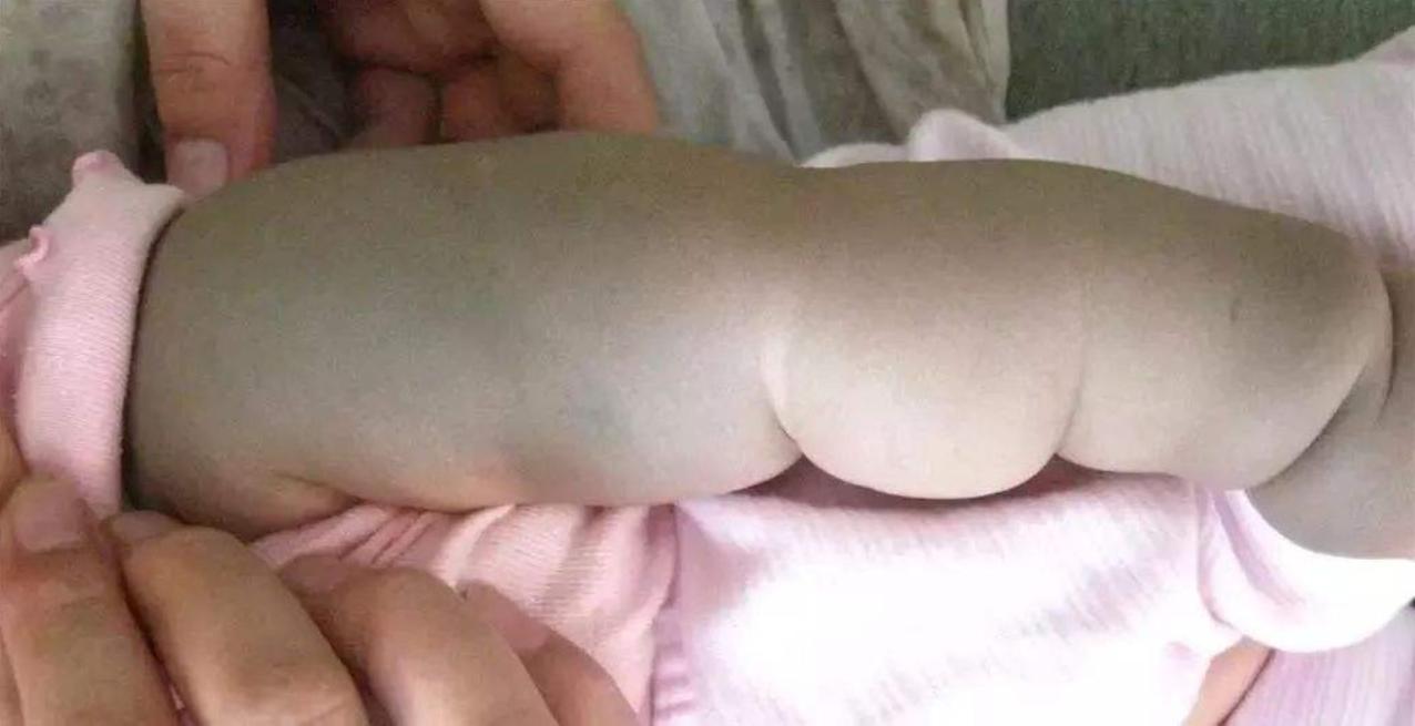 新生儿手臂上有淤青是什么原因,宝宝身上多了淤青什么引起的